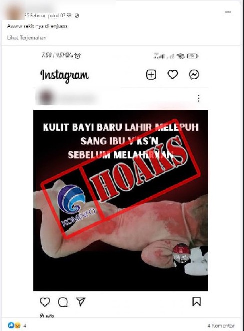 Kulit Bayi Baru Lahir Melepuh karena Sang Ibu Divaksin Covid-19