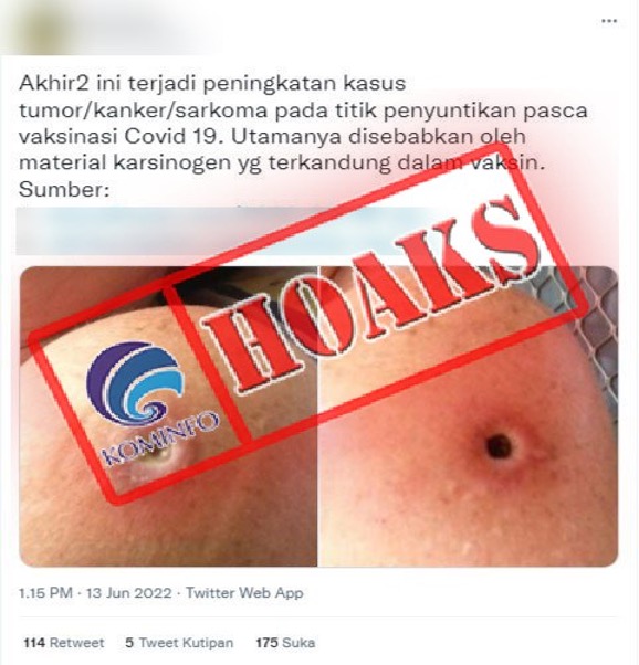 Vaksin Covid-19 Menyebabkan Peningkatan Kasus Tumor, Kanker, dan Sarkoma